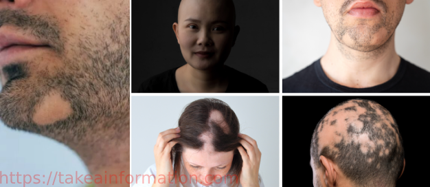 Read more about the article Understanding Alopecia Areata: Causes, Treatments, and Coping Strategies and Frequently Asked Questions